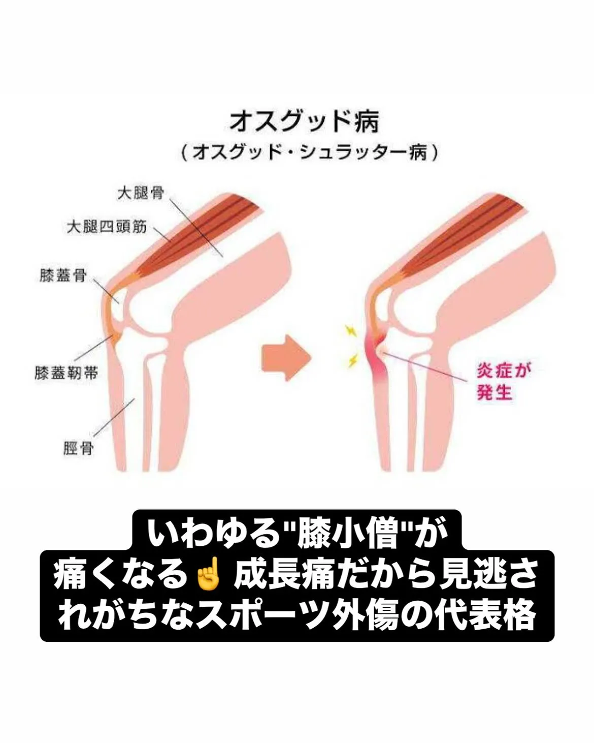 【成長痛治療なら久留米市サザン整骨院☝️】