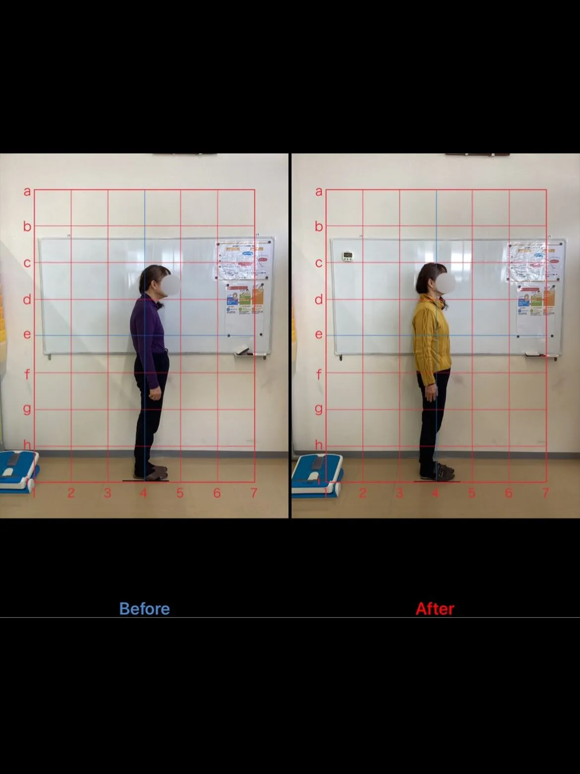 【猫背矯正は久留米サザン整骨院☝️】