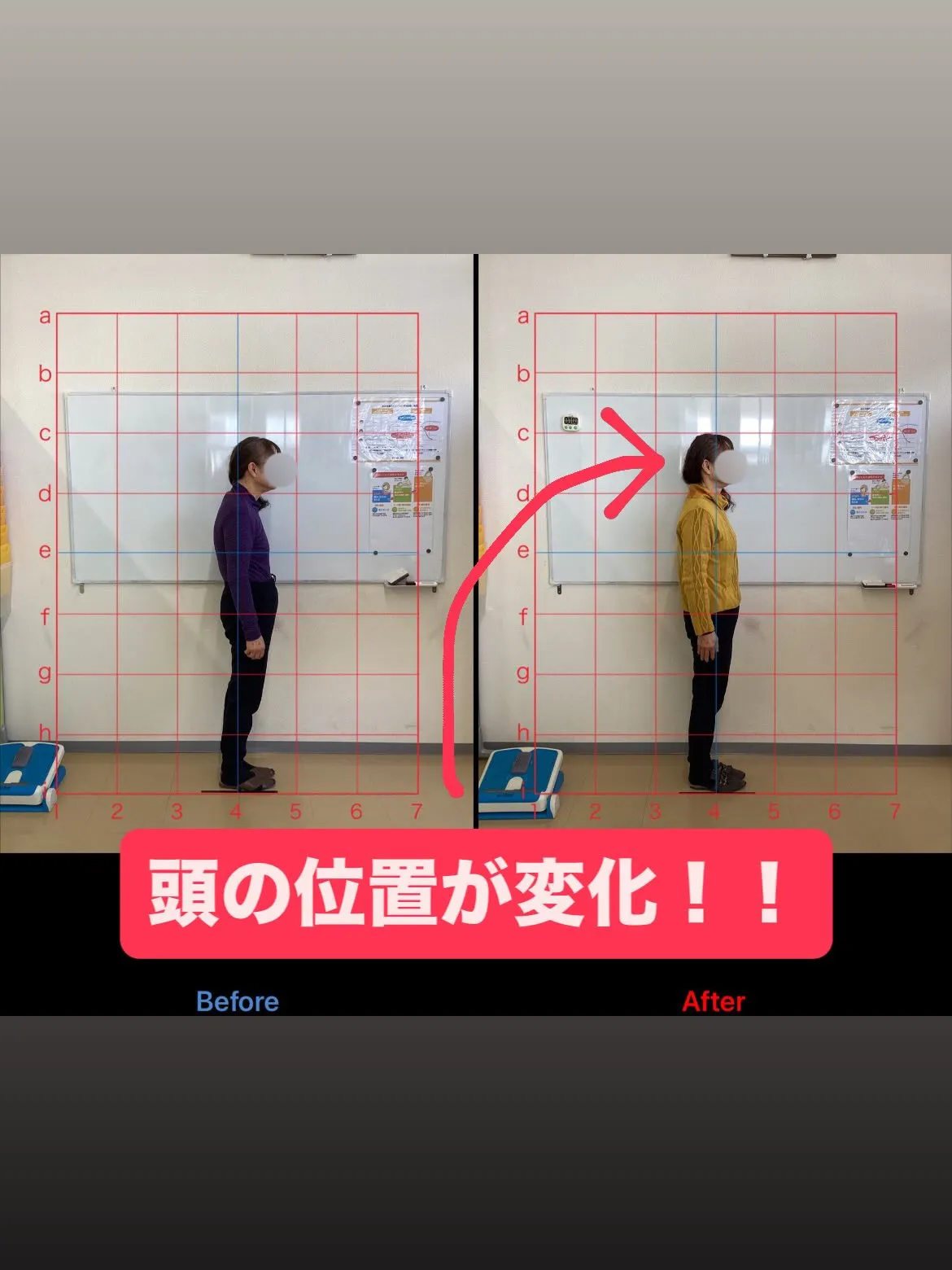 【猫背矯正は久留米サザン整骨院☝️】