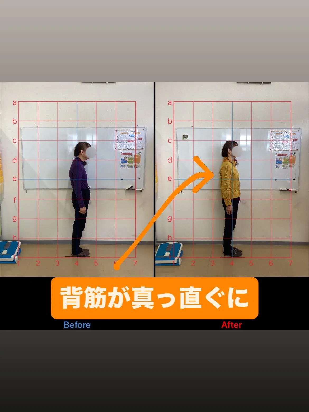 【猫背矯正は久留米サザン整骨院☝️】