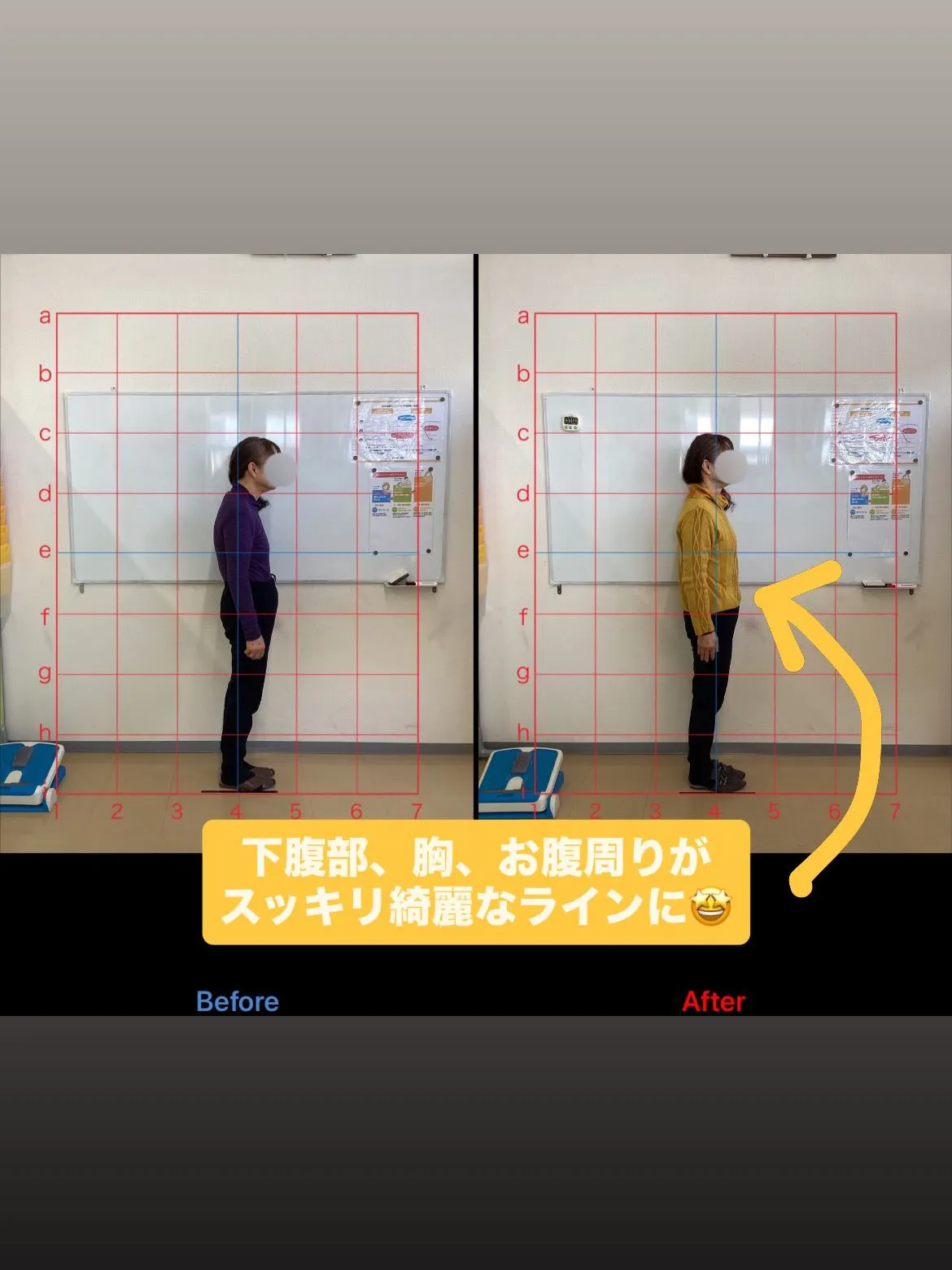 【猫背矯正は久留米サザン整骨院☝️】