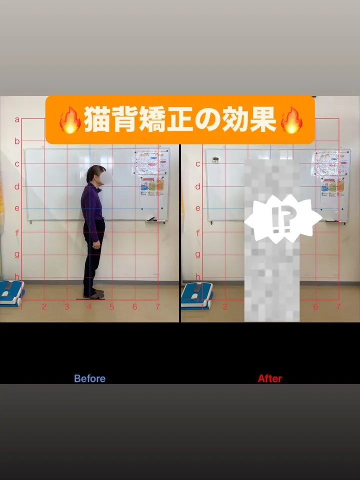 【猫背矯正は久留米サザン整骨院☝️】