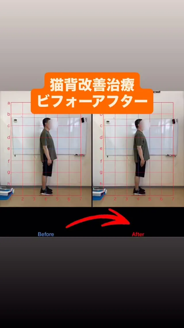 【猫背改善は久留米市サザン整骨院☝️】